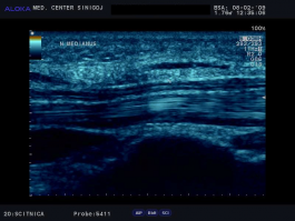 Ultrazvok karpalnega kanala - nervus medianus vzdolžno, normalen izvid